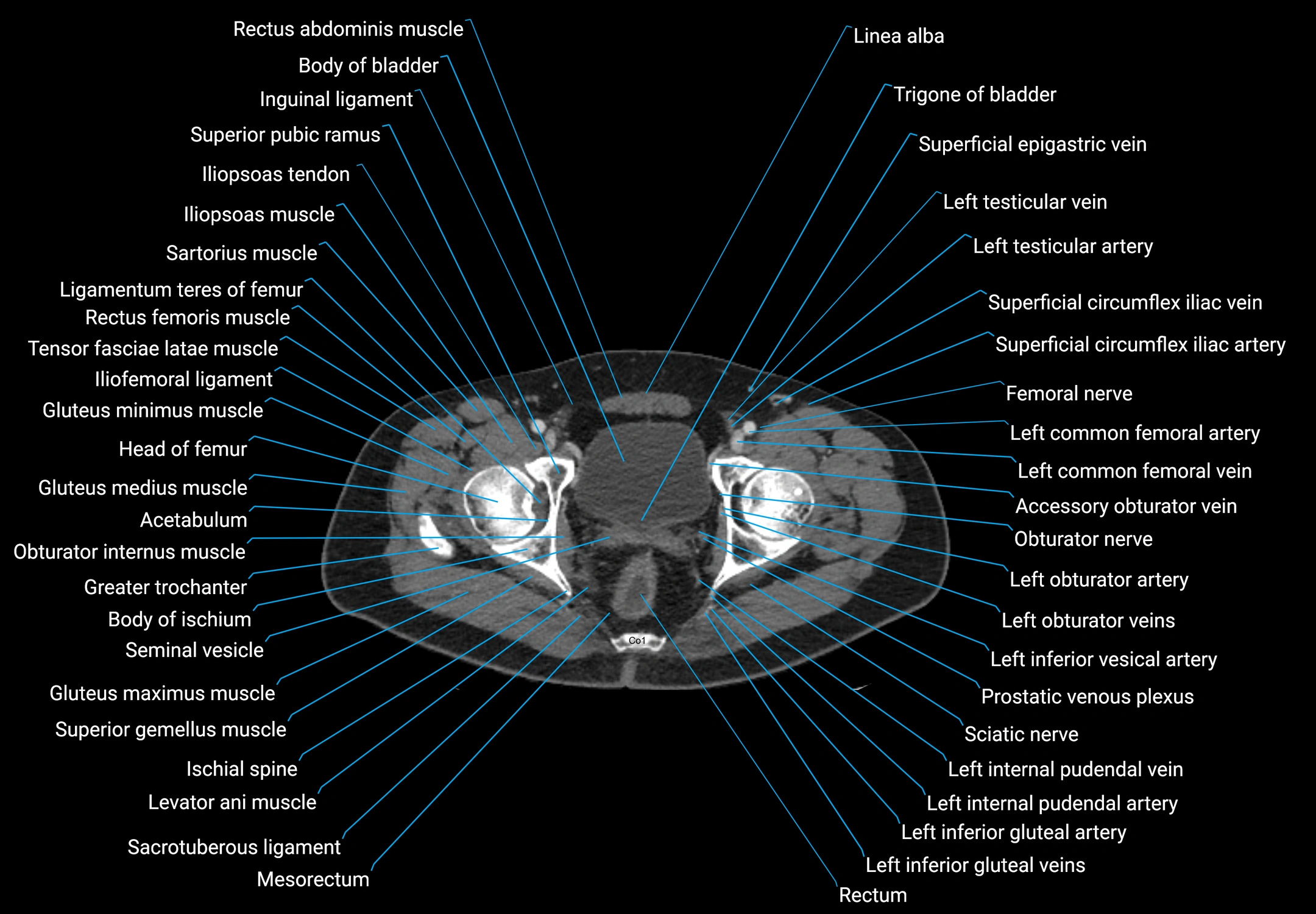 CT male pelvis axial cross sectional anatomy labelled radiology image -00186.webp